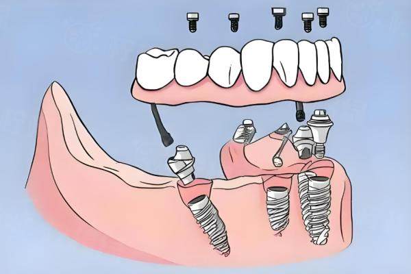 穿顴穿翼種植牙可靠嗎？是可靠的技術(shù)價格10w+揭秘適用人群及哪里能做