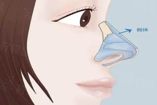 韓國原辰醫(yī)院和id醫(yī)院哪個好?ID失敗修復(fù)案例多/原辰口碑好審美佳