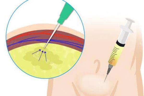 玻尿酸男性增大注射能保持幾年？1~2年，選對(duì)品牌多保持1年！