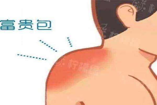 黄学峰富贵包专科怎么样?一针去除技术获赞,价格19800元起+口碑爆棚!
