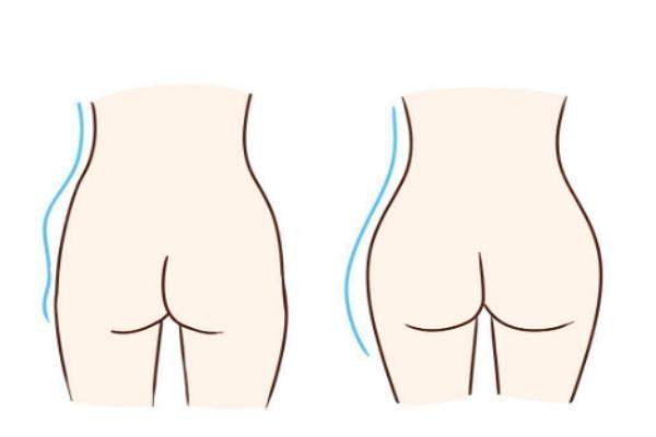 臀部?jī)蓚?cè)凹陷怎么改善？可以通過(guò)手術(shù)改善，比如吸脂/自體脂肪填充等方式