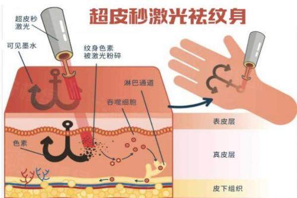 激光洗紋身和超皮秒洗紋身哪個好？從兩者原理、特點及價格來分析