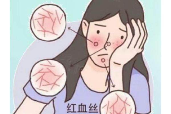 激光去红血丝成效怎么样？成效比较好，4~6次可以完成消除