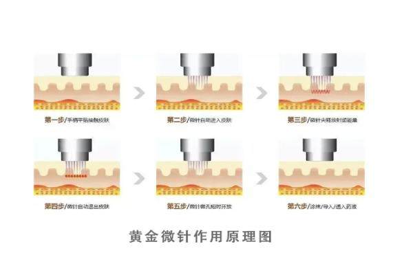 美迪邁黃金微針怎么樣？能同步實現(xiàn)抗衰+祛痘+控油縮毛孔+下頜線提升