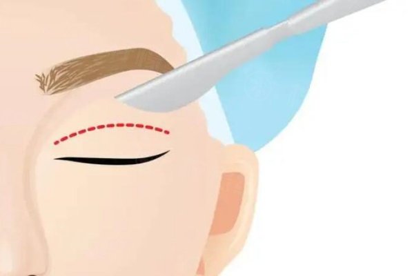 雙眼皮綜合術(shù)都包括什么？雙眼皮手術(shù)|開眼角|去眼袋|眼綜合等