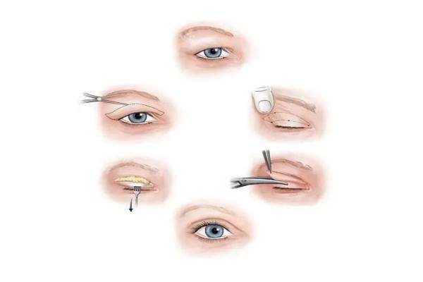 国内修复下眼皮外翻谁更好？含国内修复下眼睑退缩外翻好的医生推荐及价格