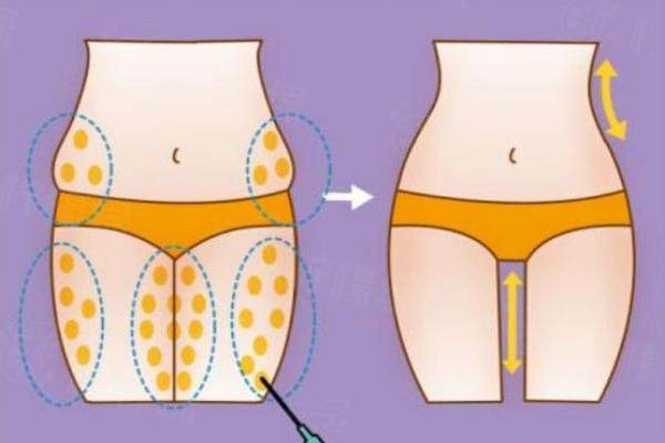 分享大腿吸脂肪的全過程,1周就可正常走路,還有大腿吸脂手術(shù)后的真實(shí)感受！