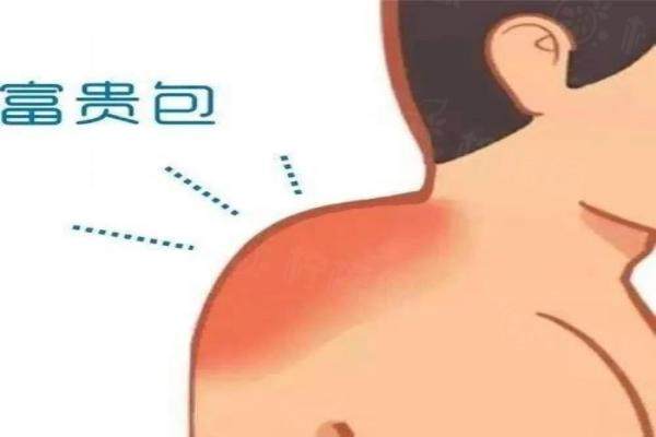黄学峰一针去除富贵包是真是假谢谢!是真的,黄学峰一针去除富贵包价格19800元+