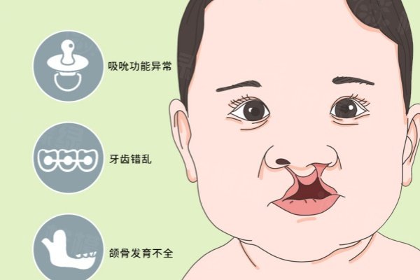 儿童唇裂修复好的医院有哪些?北京煤医/北京联合丽格/成都八大处排名前三