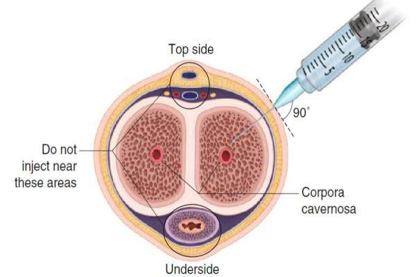 海綿體注射從哪里注射？詳細教程圖解+注射位置解析，一次看懂操作步驟！