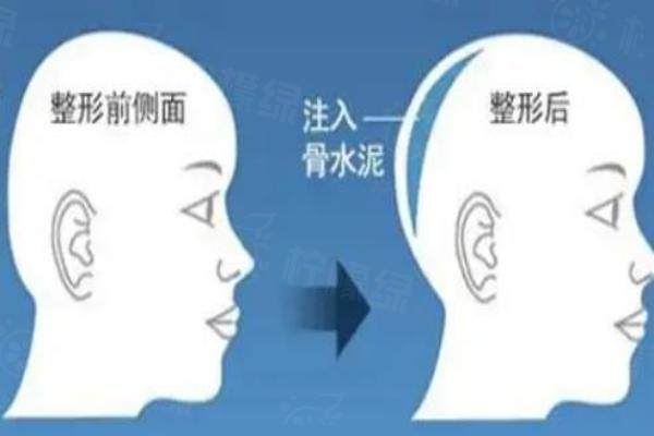 有人做過后腦勺填充手術(shù)嘛？分享后腦勺填充手術(shù)過程，做的好可以有效改善頭型