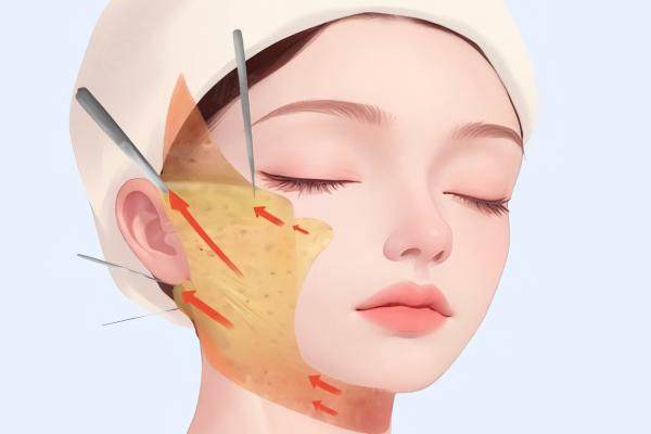 小拉皮手术费多少钱？参考小拉皮价格可知一般在8000元起一次