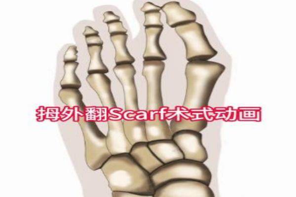 溫建民拇外翻手術(shù)預(yù)約指南來襲：包你預(yù)約成功，費(fèi)用與技術(shù)詳情解析！