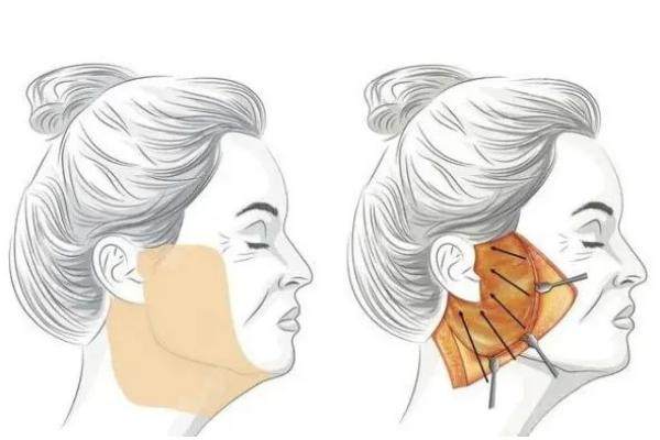 筋膜提升會(huì)讓臉變寬嗎？腫脹期暫時(shí)顯寬，1-3月恢復(fù)自然|1萬起