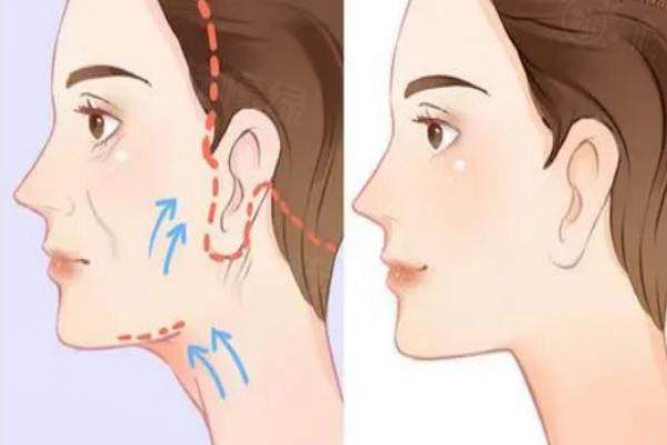 無痕筋膜提升能維持多久？可維持5-10年不等含手術(shù)過程