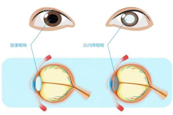 白内障晶体如何选择?看白内障晶体进口和国产的区别|价格有哪些
