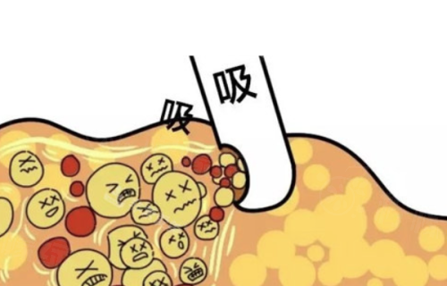 龙华新医生做吸脂怎么样？从成功案例看他吸脂手术技术好效果佳 