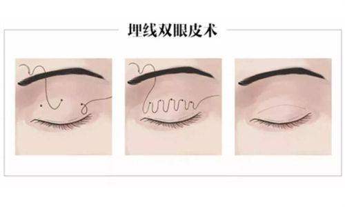 鄭州聶麗麗和楊麗修復雙眼皮那個好？2點區(qū)別秒懂鄭州聶麗麗和楊麗修復雙眼皮怎么選