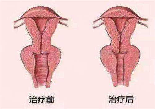 塑妍萃童顏針打了會饅化嗎？不會饅化，揭秘塑妍萃童顏針能維時間+價格！