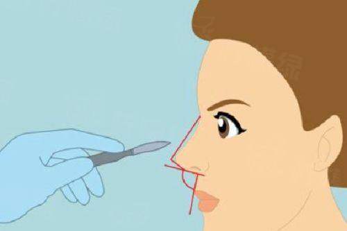 二、蘇州龔祥醫(yī)生做鼻綜合多少錢(qián)？