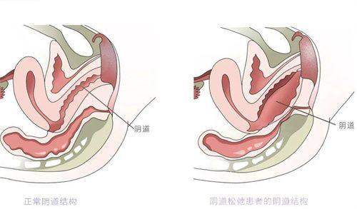 二、皮貼骨針多少錢一針？