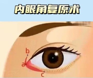 陳芝修復(fù)內(nèi)眼角怎么樣？陳芝修復(fù)內(nèi)眼角口碑好附修復(fù)內(nèi)眼角案例 