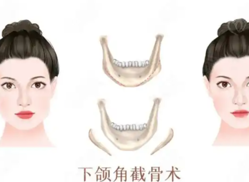 穆雄錚磨骨技術(shù)怎么樣？多例成功磨骨案例揭秘其高超技術(shù)，穆雄錚會(huì)親自做手術(shù)！ 