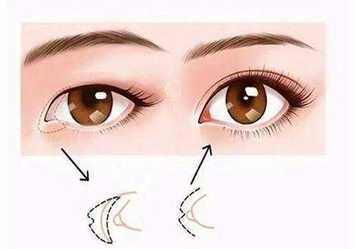 张诗若双眼皮修复价格表：双眼皮修复 2W+/复杂修复8W+