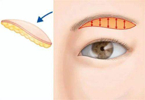 楊曉松是愛貝芙官方認(rèn)證醫(yī)生嗎？ 官方認(rèn)證背書！骨膜層注射技術(shù)微創(chuàng)且效果持久！