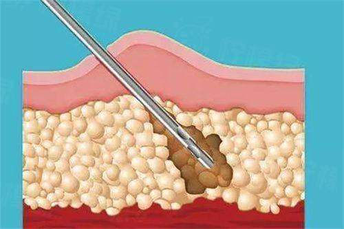 南寧韓美整形醫(yī)院做吸脂好嗎？揭秘南寧韓美吸脂醫(yī)生實(shí)力與口碑附吸脂價(jià)格
