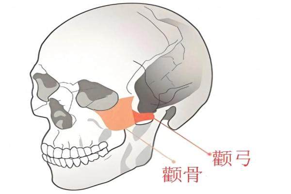 顴骨內(nèi)推是怎么做的？通過截骨固定方式，效果對(duì)薄肌肉人群更明顯！