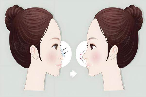 武漢吳輝醫(yī)生做鼻子怎么樣？資深鼻部專家，以自然仿生技術(shù)著稱，價格透明，案例說話