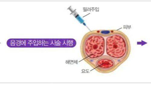 濟(jì)南李輝醫(yī)生做隆鼻手術(shù)怎么樣？李輝醫(yī)生做隆鼻手術(shù)口碑不錯(cuò)眾多隆鼻修復(fù)案例見證其精細(xì)技術(shù)