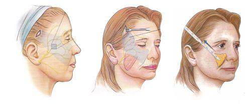 三、汪樹杰和裴柄萬雙眼皮修復(fù)價格