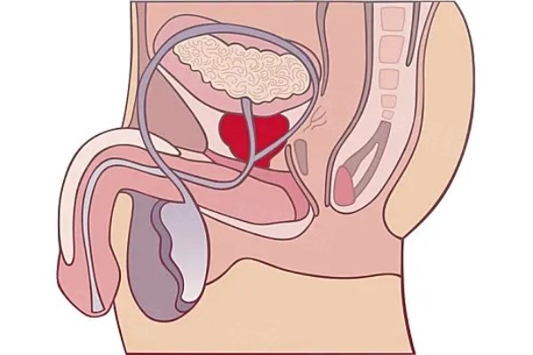 李世榮做一次延長(zhǎng)手術(shù)多少錢？單純延長(zhǎng)術(shù)6.8W+延長(zhǎng)增粗術(shù)8W+高難度修復(fù)術(shù)12.8W+