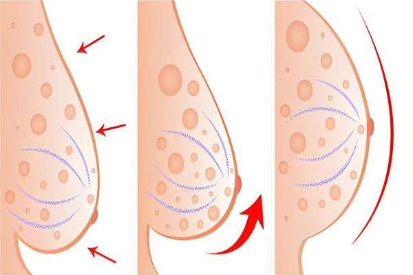 西寧乳房懸吊術(shù)哪家醫(yī)院做的好？西寧澳麗醫(yī)療美容醫(yī)院/西寧時(shí)光整形美容醫(yī)院/西寧韓美美容醫(yī)院上榜前三！ 
