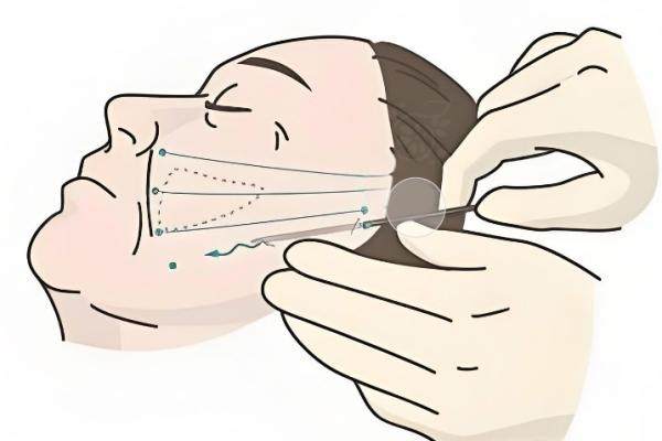 杜太超醫(yī)生全國排名第幾？國內(nèi)前五實力強可微信/電話約拉皮手術(shù)+3萬起