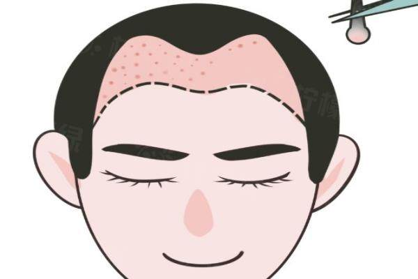 福州海峽植發(fā)科醫(yī)院怎么樣？技術(shù)出色+口碑好附醫(yī)生蘇雪飛/吳淑芬經(jīng)驗豐富