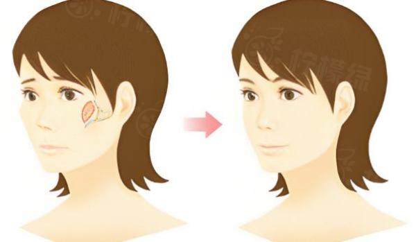 何照華磨骨案例分享：介紹四例真實(shí)案例找何照華做磨骨手術(shù)