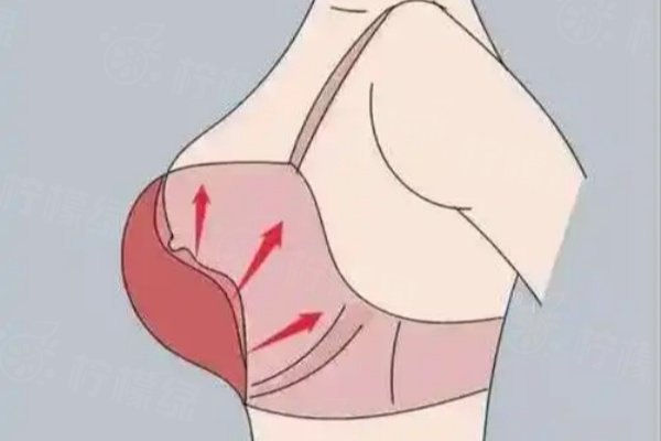 重慶曹勇做巨乳縮小怎么樣？疤痕不明顯，患者滿意度高|口碑更是杠杠滴！ 