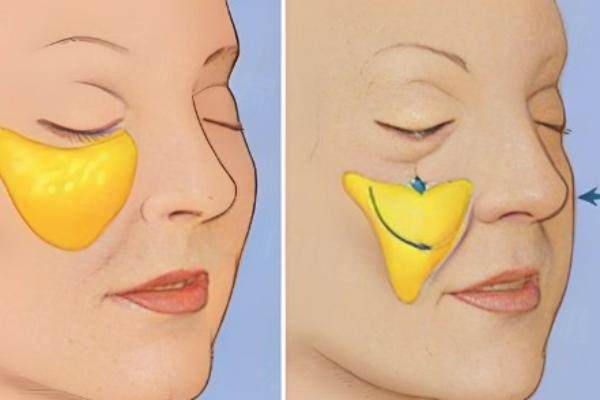 韓國(guó)面部輪廓手術(shù)哪家醫(yī)院做的好？原辰、菲斯萊茵、ID等熱門口碑醫(yī)院排名推薦