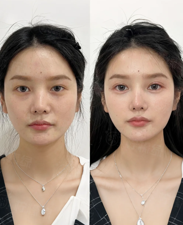 廣州柳超在的醫(yī)院是什么資質(zhì)？韓妃擁有四級頜面手術(shù)資質(zhì)；柳超醫(yī)生技術(shù)怎么樣？看上萬例手術(shù)積累的熟練度與安心性