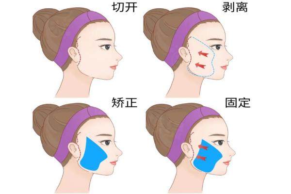 郭玉瑞小切口拉皮有失敗實(shí)例嗎？檔次如何？實(shí)測(cè)反饋來(lái)了