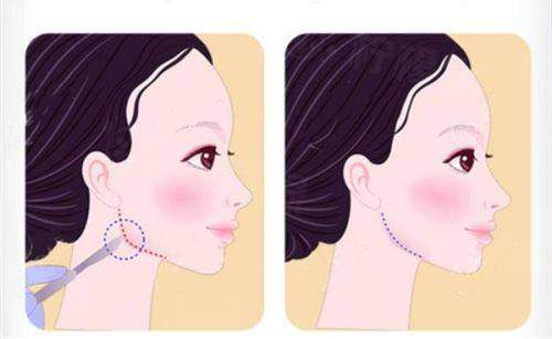 廣州建國醫(yī)院做陰道緊縮術(shù)好不好？我親身經(jīng)歷的恢復(fù)情況