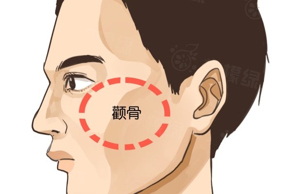 高占巍顴骨修復(fù)價錢明細公開：單純顴骨截骨18000+顴骨+軟組織聯(lián)合修復(fù)35000+