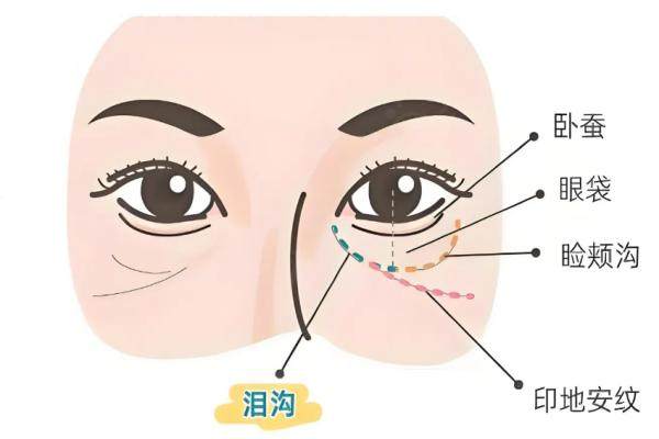 自體脂肪填充淚溝的弊端是不是會(huì)下移？我填后6個(gè)月：移位沒發(fā)生，保持時(shí)間取決于存活