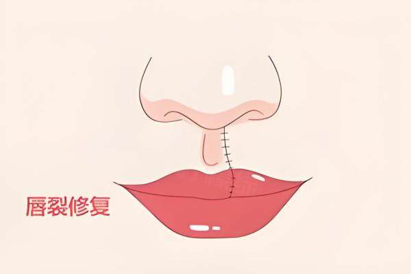 唇裂修復(fù)我國有補助嗎？山東免費手術(shù)+217家定點機構(gòu)申請流程