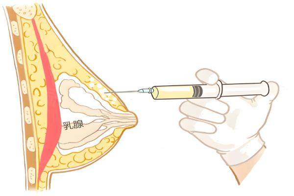 薇庭美注射豐胸好不好？真實體驗后，薇庭美豐胸多少錢一支區(qū)間