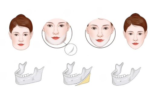 上海華美拉皮手術(shù)做的好嗎？真人案例多，醫(yī)生經(jīng)驗(yàn)足