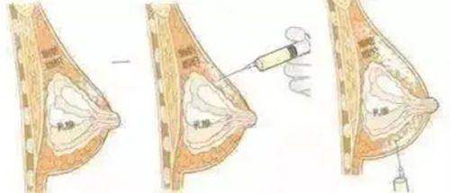 成都友誼醫(yī)院做狐臭手術(shù)怎么樣？傳統(tǒng)/微創(chuàng)術(shù)式價格差多少？